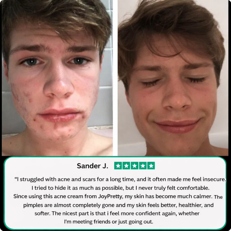 JoyPretty – Acne Cream | Blemish & Scar Care