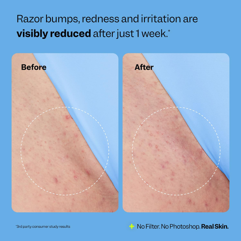 Maravelle – Smooth Relief Roller | Ingrown Hair Relief